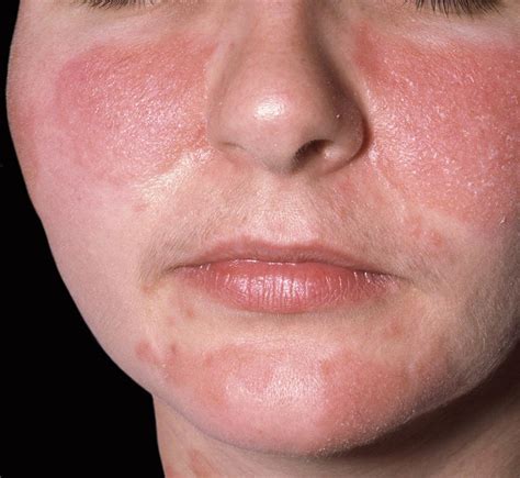 Mask Related Acne Maskne And Other Facial Dermatoses The Bmj