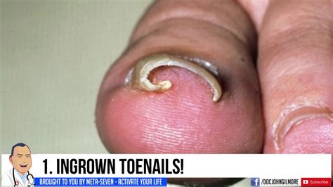 Most Popular Ingrown Nails Cysts And Pimple Pops Search Rankings