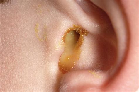 ear infection photograph by dr p marazzi science photo library