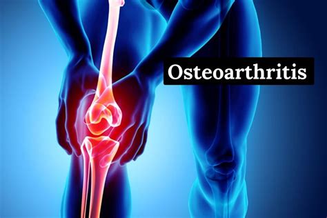 Osteoarthritis Symptoms Treatments And Causes Go Lifestyle Wiki