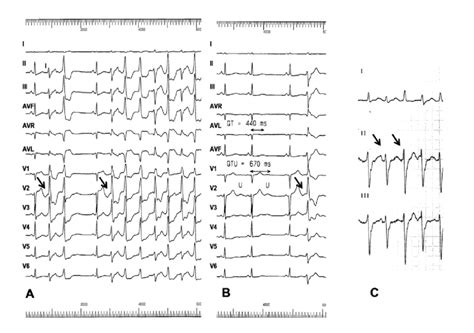 A Twelve Lead ECG 25 Mm S Of Our Patient With Repetitive Sustained