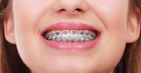 Teeth Braces In Brighton And Hove Clear Braces Splash Orthodontics