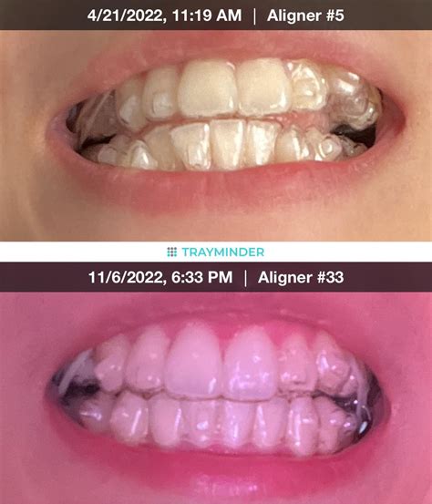 About 6 Months In Seeing Changes And Its Amazing Rinvisalign