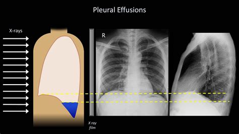 How To Interpret A Chest X Ray Lesson Diaphragm And Pleura Youtube