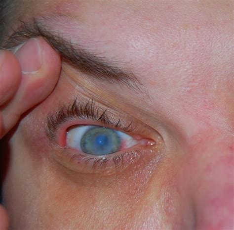 Cataracta o boală a ochilor care afectează şi tinerii Care sunt cauzele şi simptomele cataractei