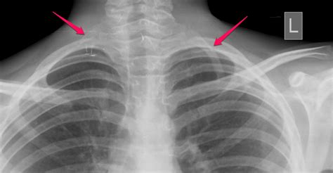 X Ray Showing Bilateral Cervical Ribs Download Scient