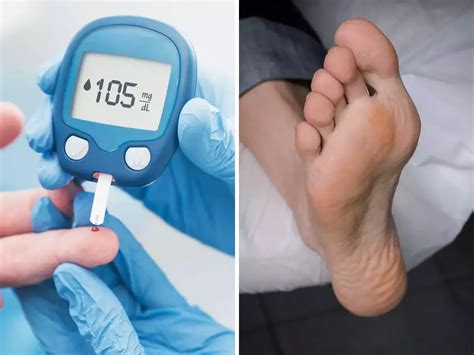 Diabetes Symptoms In Your Feet Seven Signs That Indicate High Blood