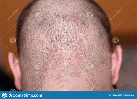 Back Side Of A Man`s Head Suffering From Scalp Acne Stock Image Image