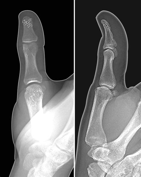 Thumb Distal Phalanx Fracture Hand Surgery Source