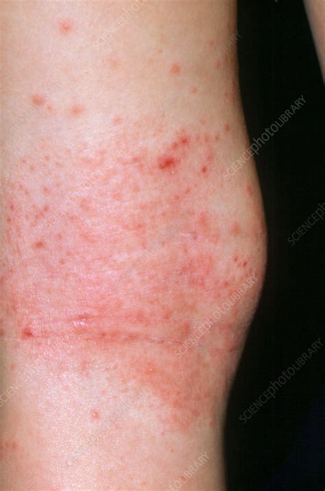 Eczema Rash On A Childs Knee Stock Image M1500052 Science Photo