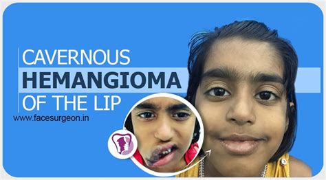 Cavernous Hemangioma Of The Lip Hemangioma Corrective Surgery