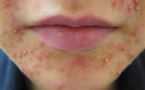 Acne Around Mouth Or Chin Causes And Treatments Skincarederm