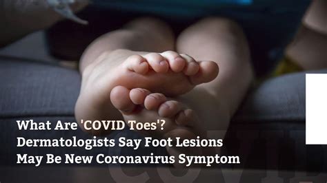 What Are Covid Toes Dermatologists Say Foot Lesions May Be New