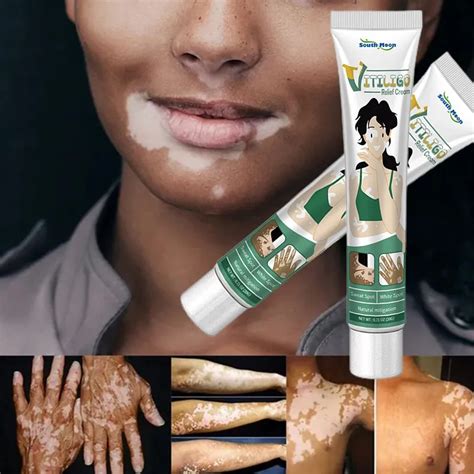 Herbal Extract Vitiligo Ointment Remove Ringworm White Spot Removal