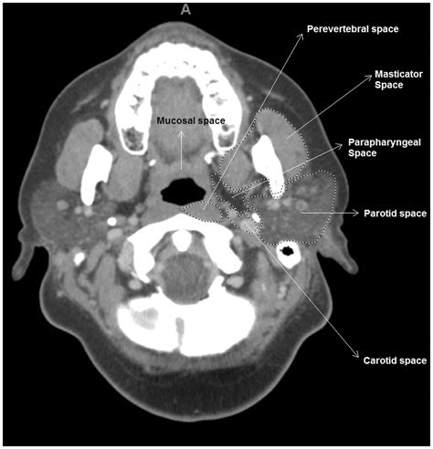Heavily Calcified Parapharyngeal Space Mesenchymal Chondrosarcoma