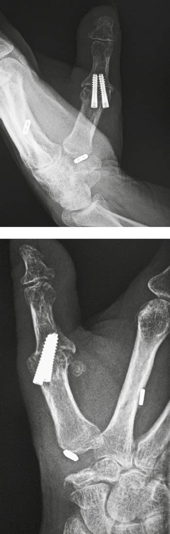 3 Fracture Fixation Radiology Key