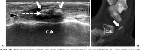 Figure 14 From Ultrasound Of Peroneal Tendons Semantic Scholar