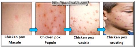 Clinical Manifestations And Treatment Chickenpox Varicella