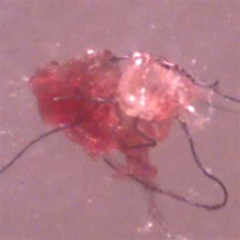 What Is Morgellons Disease Is It A Physical Or Psychological Condition