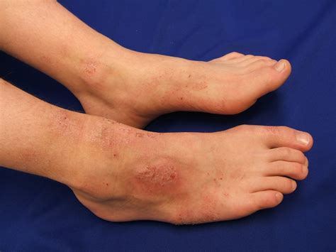 Atopic Dermatitis Symptoms Causes Treatment Triggers