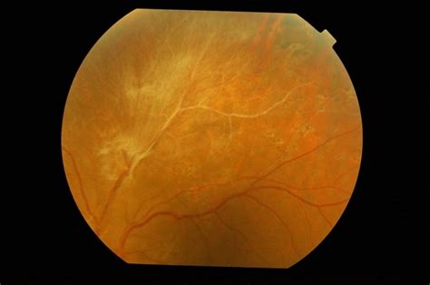 Brvo With Proliferative Retinopathy Retina Image Bank