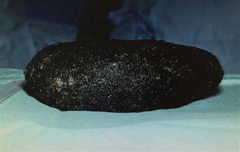 sophie cox had 14lb hairball removed from stomach after eating hair in her sleep for 7 years