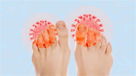 Are Covid Toes A Real Symptom Of The Virus