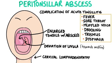 Peritonsillar Abscess Cause Presentation Diagnosis Treatment Youtube