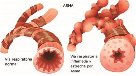 Todo Lo Que Debes Saber Sobre El Asma Ataques Asm Ticos Bezzia