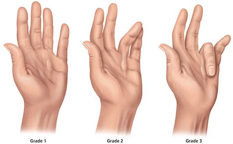 Dupuytrens Contracture Causes Symptoms Treatment