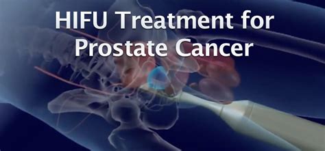 New Prostate Cancer Treatment Using High Intensity Focused Ultrasound HIFU Under Review By FDA