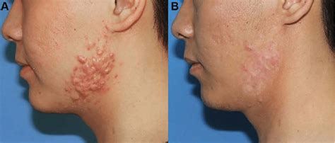 A Patient With Multiple Lesions Of Keloids On His Face Prior To