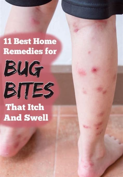 These Are The 11 Best Home Remedies For Bug Bites That Itch And Swell