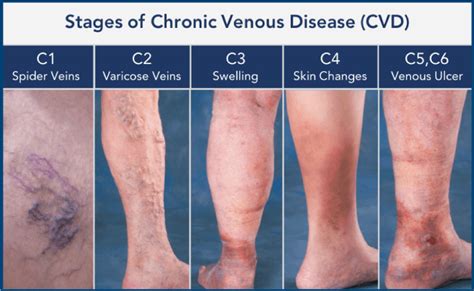 Venous Stasis Ulcer Stages