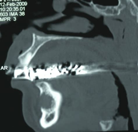 Lower Jaw Cyst Lower Jaw Cyst Kazemi Oral Surgery