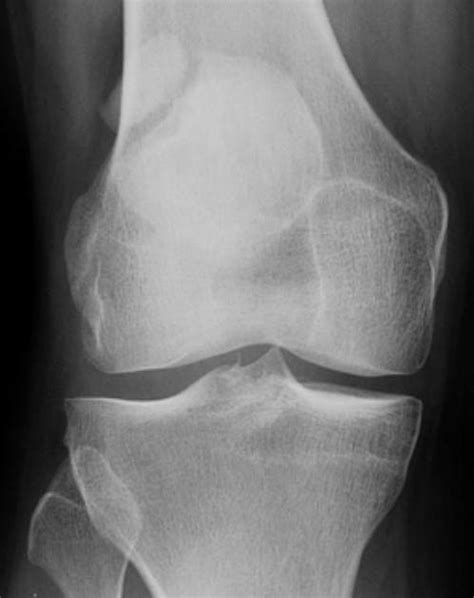 Also seen is some trochlea (groove of femur) dysplasia (abnormal shape). Knee X-rays