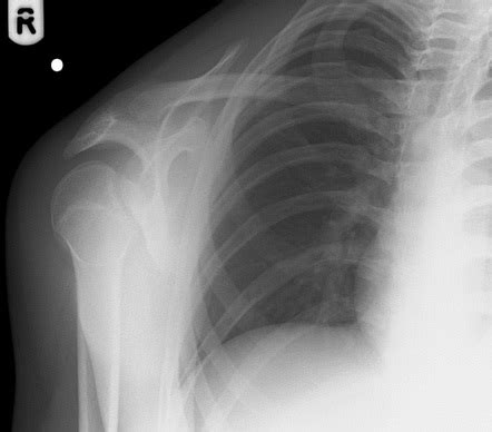 Lightbulb Sign Shoulder Dislocation Radiology Reference Article Radiopaedia Org