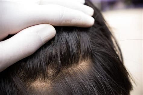 How To Identify And Get Rid Of Head Lice