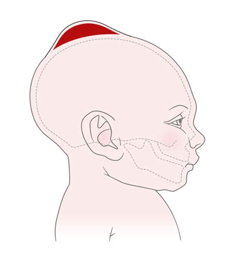 Newborn Cephalohematoma Causes Diagnosis Symptoms