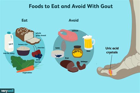 Foods low or moderate in purine are a key part of avoiding painful attacks. Gout: What to Eat for Better Management