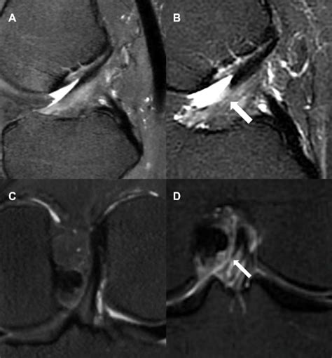 Example Magnetic Resonance Images Of Knees With Normal Anterior