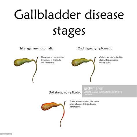 Gallbladder Disease Stages Illustration High Res Vector Graphic Getty