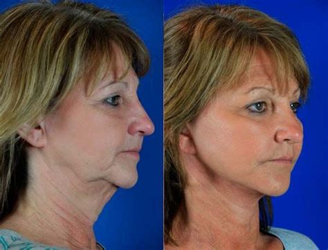 Kathy 55 Before And After She Underwent Faceneck Lift Including Liposculpting Of The Jowls
