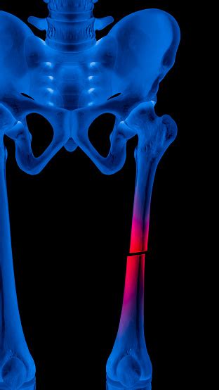 Broken Upper Leg Bone Injury Of Thighbone Or Femur
