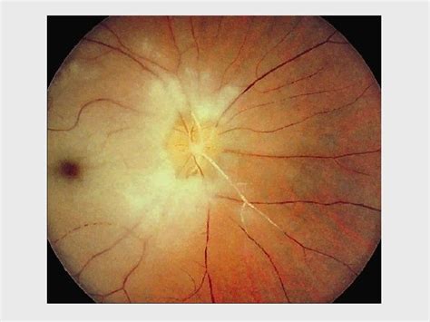 Vascular And Hereditary Retinal Disease