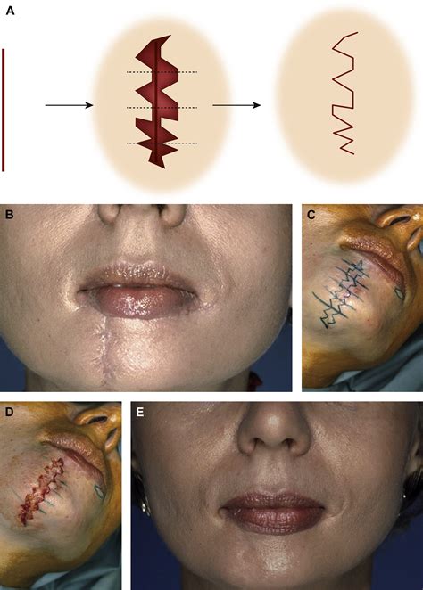 scar revision and recontouring post mohs surgery facial plastic surgery clinics