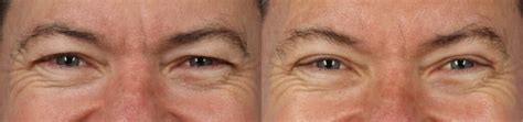 What Age Is Normal To Get Wrinkles Philip Miller Md
