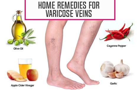 Varicose Veins Causes Symptoms And Remedies