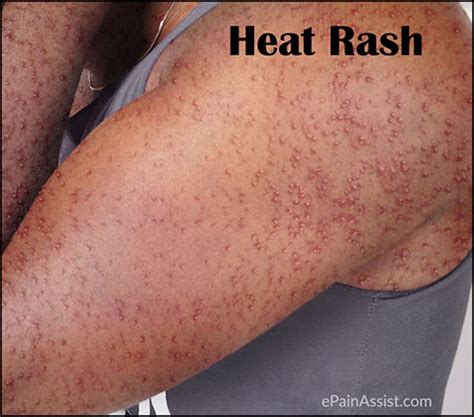 Prickly Heat Rashes Pictures Photos