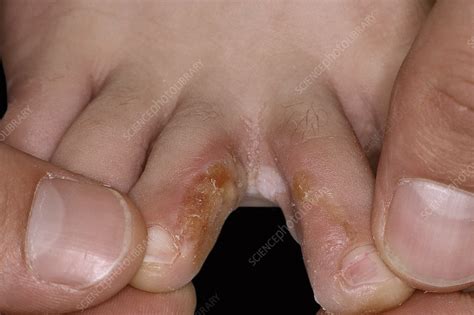 Ringworm Fungal Infection Of The Foot Stock Image C0514574